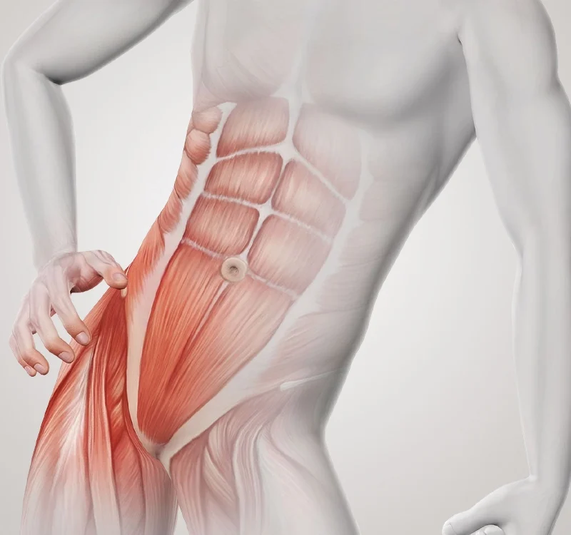 Factores de riesgo que aumentan la probabilidad de una hernia | Dr. Saúl Echeverría - Cirujano General y Laparoscópico en El Salvador