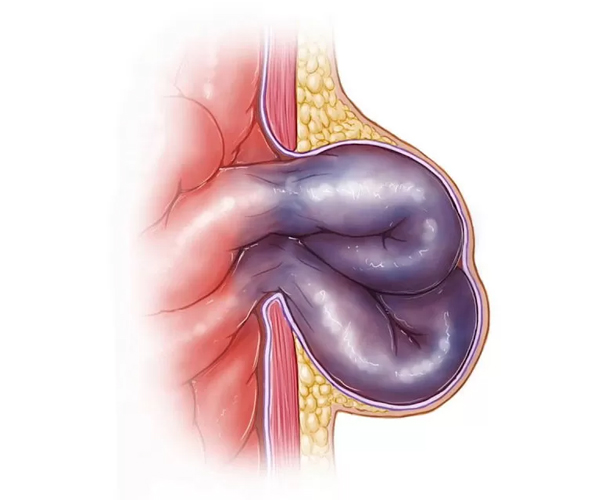 Hernia estrangulada: ¿cuál es la diferencia y cuándo preocuparse? | Dr. Saúl Echeverría - Cirujano General y Laparoscópico en El Salvador