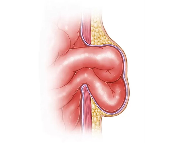 Hernia incarcerada: ¿cuál es la diferencia y cuándo preocuparse? | Dr. Saúl Echeverría - Cirujano General y Laparoscópico en El Salvador