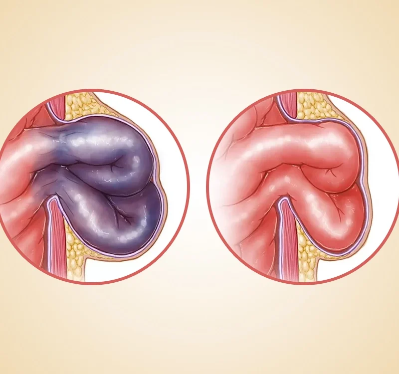 Hernia incarcerada vs. estrangulada: ¿cuál es la diferencia y cuándo preocuparse? | Dr. Saúl Echeverría - Cirujano General y Laparoscópico en El Salvador