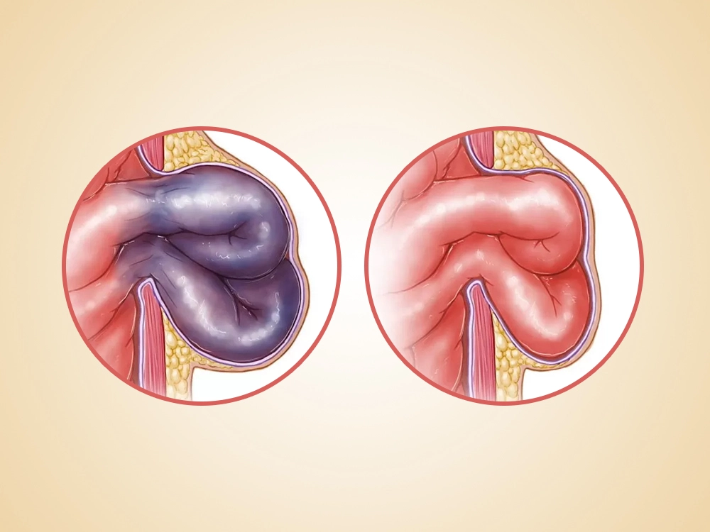 Hernia incarcerada vs. estrangulada: ¿cuál es la diferencia y cuándo preocuparse? | Dr. Saúl Echeverría - Cirujano General y Laparoscópico en El Salvador