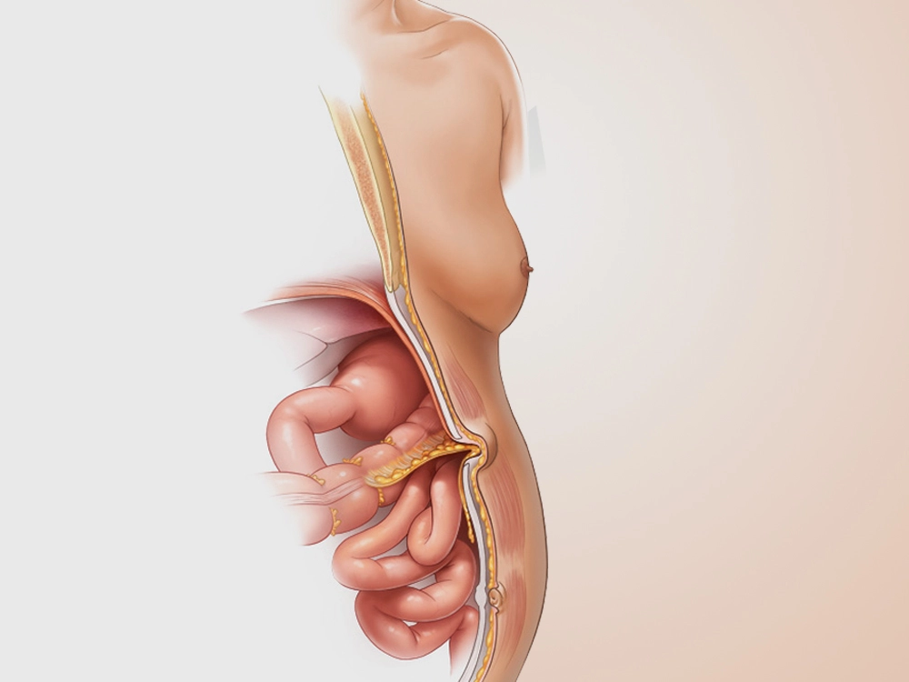 Cómo identificar los primeros síntomas de una hernia | Dr. Saúl Echeverría - Cirujano General y Laparoscópico en El Salvador