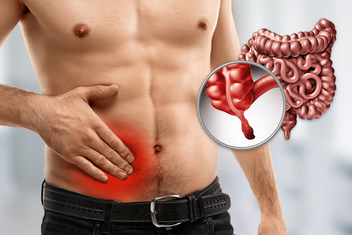 Cirugía de Apéndice | Dr. Saúl Echeverría – Cirujano general y laparoscópico en El Salvador