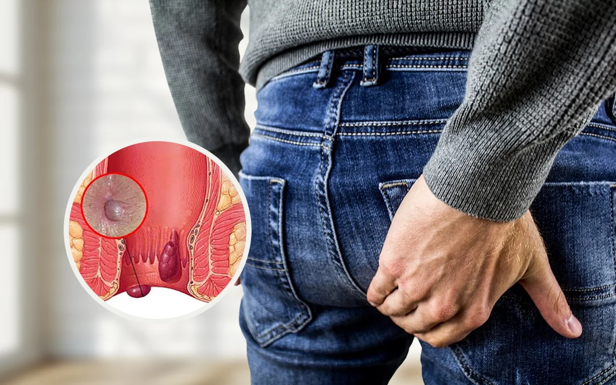 ¿Por qué aparecen las hemorroides? Identifica las causas y cuida tu salud | Dr. Saúl Echeverría – Cirujano general y laparoscópico en El Salvador
