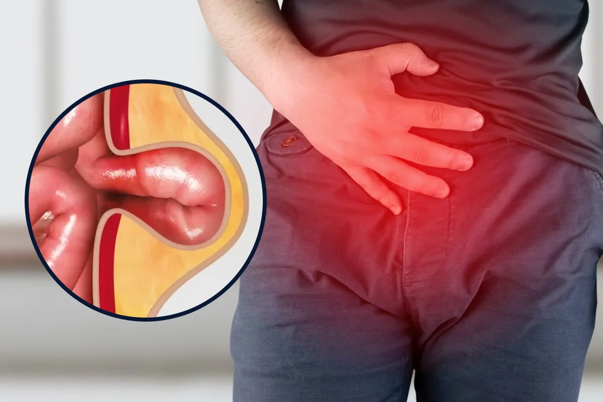 Cirugía de Hernias | Dr. Saúl Echeverría – Cirujano general y laparoscópico en El Salvador