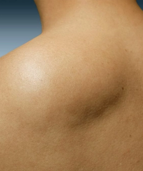 Cirugía de Extirpación de Lipoma | Dr. Saúl Echeverría – Cirujano general y laparoscópico en El Salvador